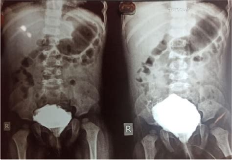 mcu full form medical|Children’s (Paediatric) Micturating Cysto.